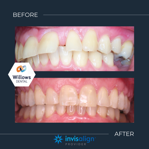 Invisalign Treatment Before and After