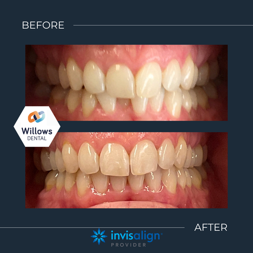 Orthodontic Treatment Before and After