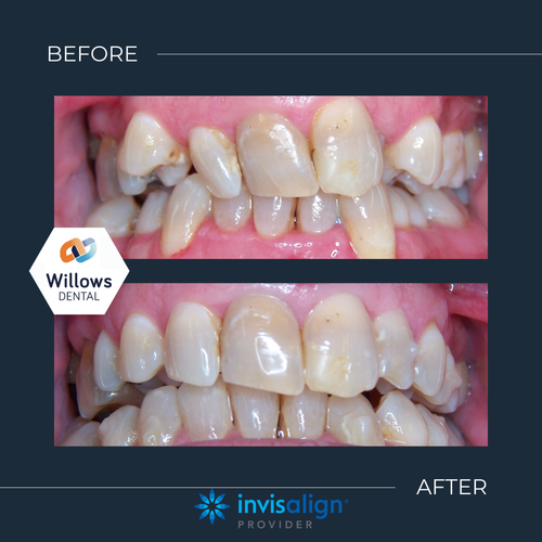 Cosmetic Dentistry Before and After